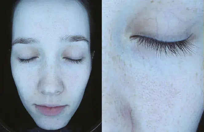 Derma-Vu Photographic Skin Analysis Machine With AI Technology