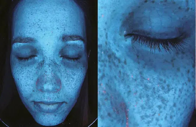Derma-Vu Photographic Skin Analysis Machine With AI Technology